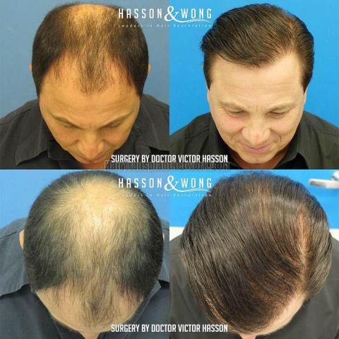 Top view - Before and after surgical hair replacement