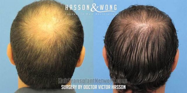 Hair restoration procedure before and after result images