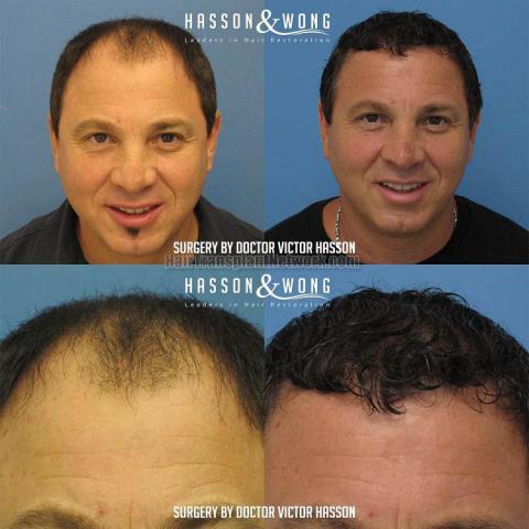 Hair transplant surgery before and after pictures