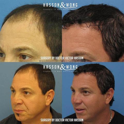 Surgical hair transplantation result photographs