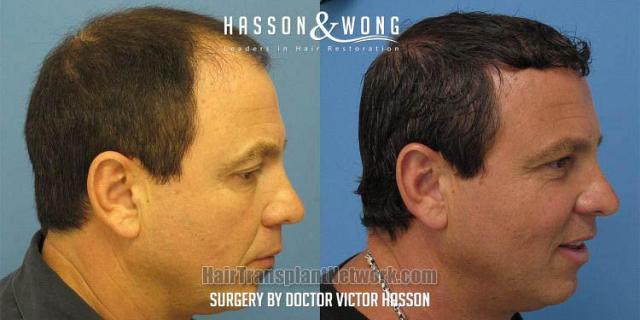 Hair transplant surgery before and after images