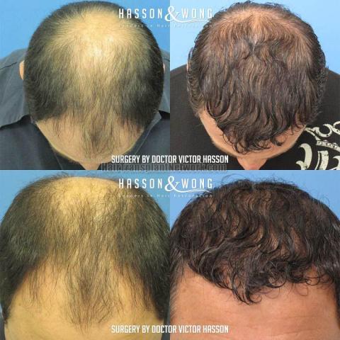 Hair restoration procedure before and after pictures