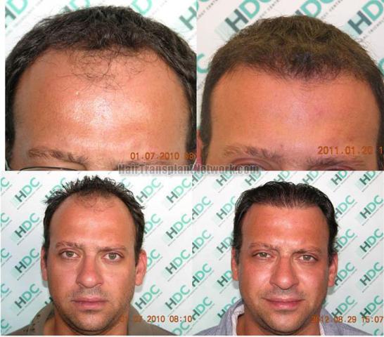 Hair restoration procedure before and after results