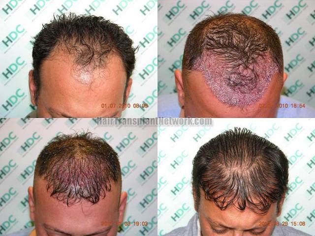 Hair transplantation surgery before and after photos