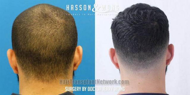 Hair replacement surgery before and after images