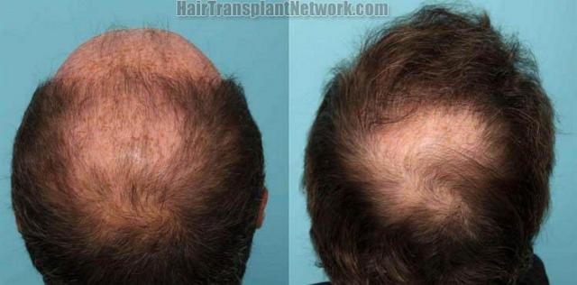 Crown / Back view of hair transplant surgical procedure