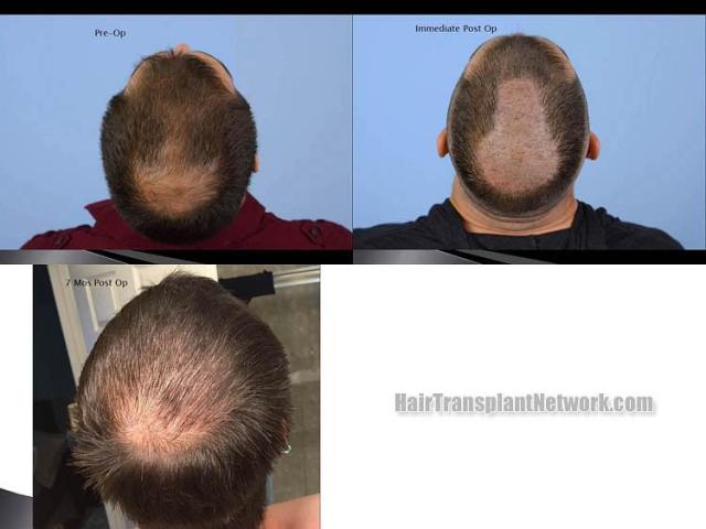 Hair transplantation surgery before and after images