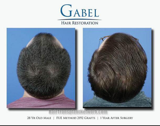 Surgical hair transplantation result photographs