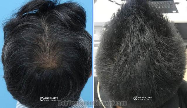 Hair replacement surgery before and after images