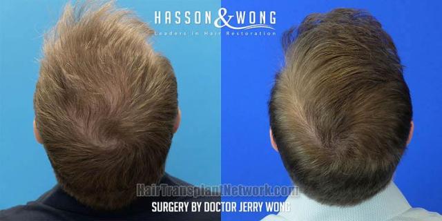 Surgical hair transplantation result photographs