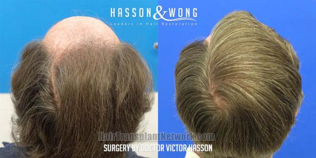 Surgical hair transplantation result photographs