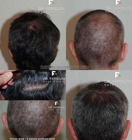 Hair transplantation surgery before and after images