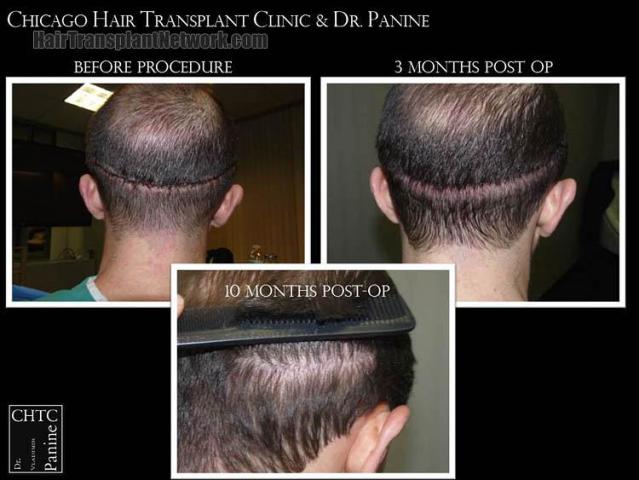 Hair restoration procedure before and after pictures