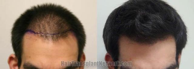 Hair transplantation surgery before and after images