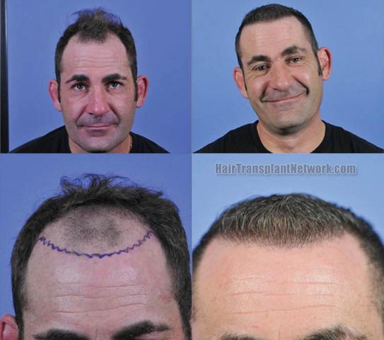 Hair restoration procedure before and after results