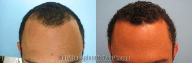 Hair restoration procedure before and after results