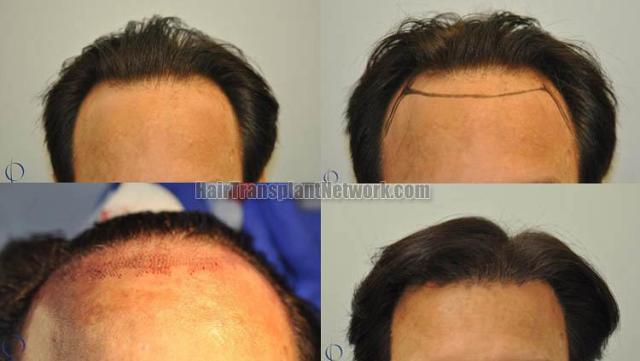 Hair transplantation surgery before and after photos