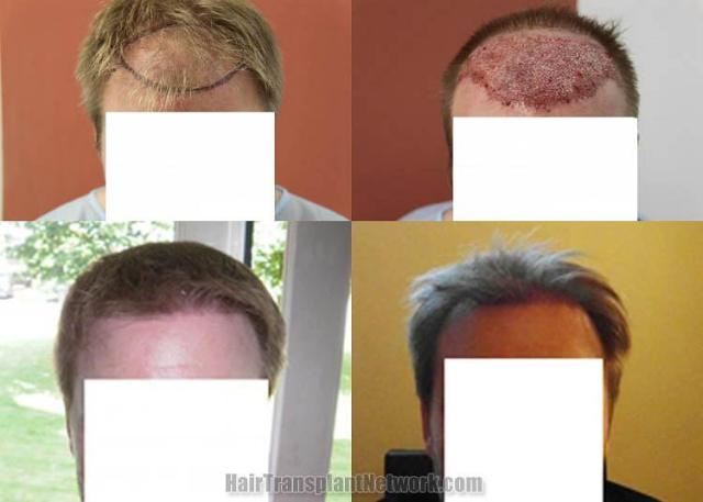 Hair restoration procedure before and after results