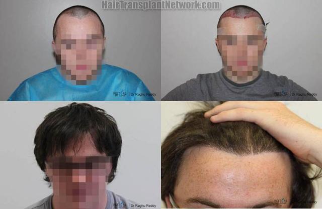 Hair restoration procedure before and after results