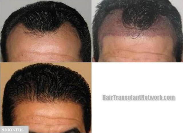 Before and after hair transplantation result photographs