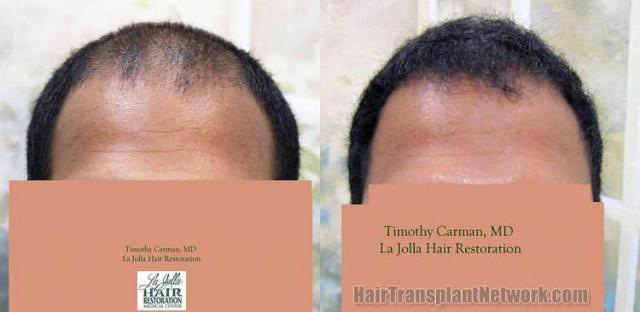 Hair restoration procedure before and after results