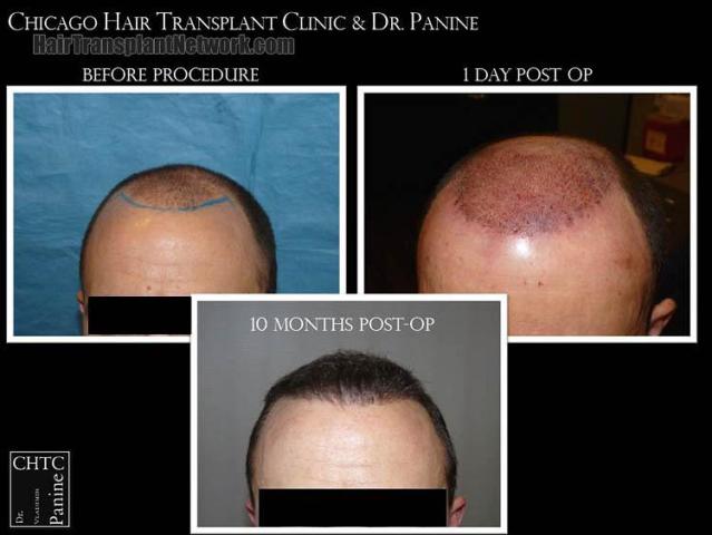 Hair restoration procedure before and after results