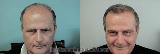 Hair restoration procedure before and after results