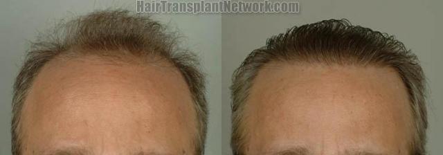 Hair restoration procedure before and after results