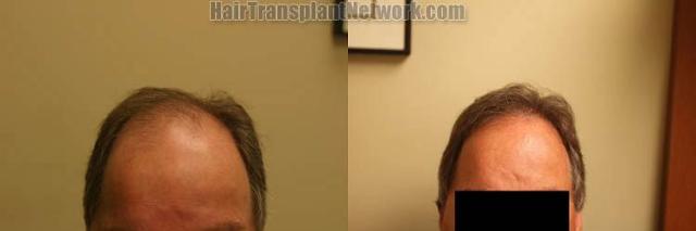 Hair restoration procedure before and after results