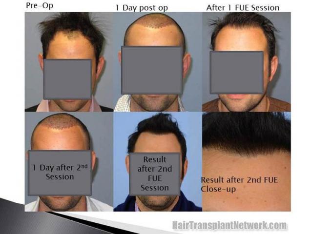 Hair restoration procedure before and after results