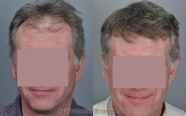 Hair transplantation surgery before and after photos