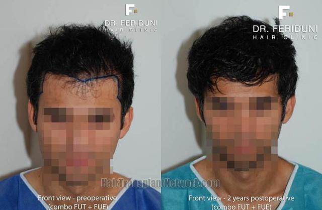 Before and after hair transplantation result photographs