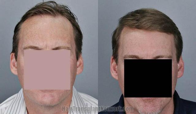 Hair transplantation surgery before and after photos