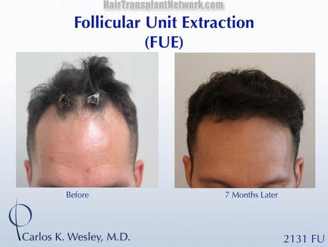 Before and after hair transplant procedure images