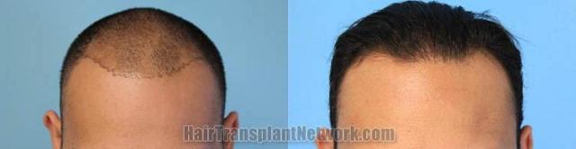 Hair restoration procedure before and after results