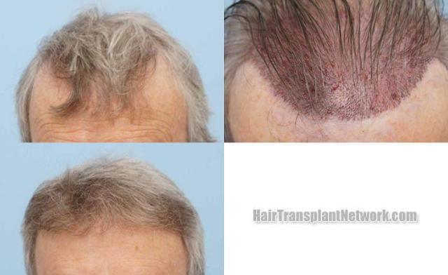 Before and after hair transplant procedure images