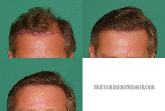 Front view - Before and after hair transplantation surgery