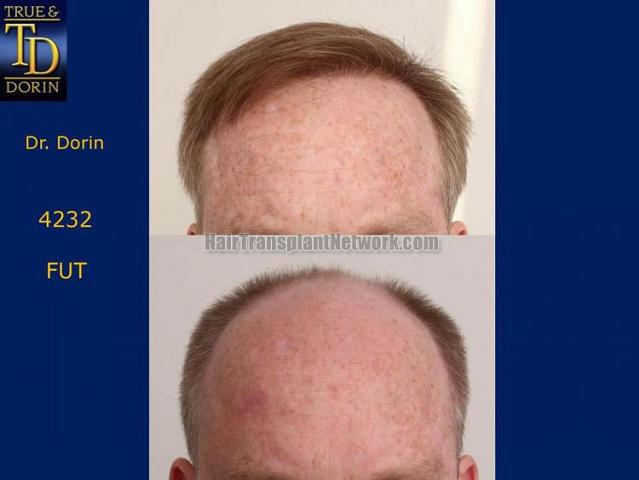 Before and after hair restoration procedure images