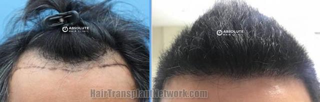 Front view - Before and after hair restoration procedure