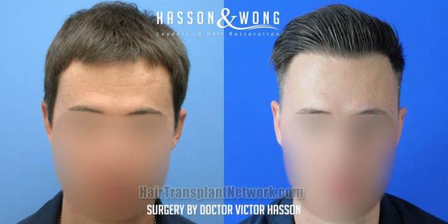 Front view - Before and after hair restoration procedure