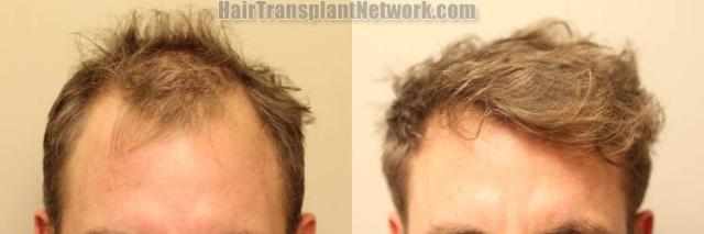 Front view - Before and after hair restoration procedure