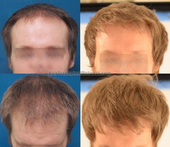 Hair restoration procedure before and after results