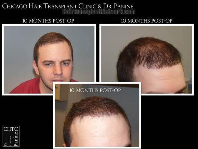 Hair transplant surgery ten months postoperative