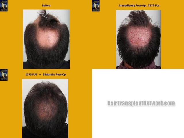 Hair restoration procedure before and after pictures