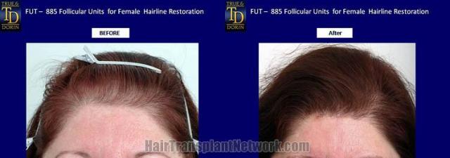 Hair restoration procedure before and after results