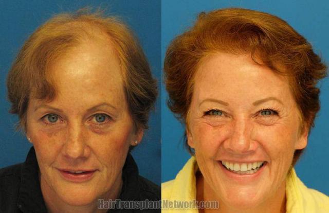 Hair transplantation surgery before and after photos