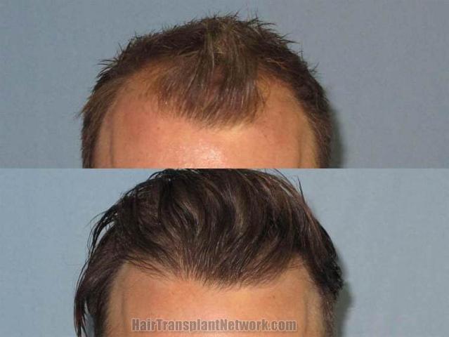 Hair transplantation surgery before and after images