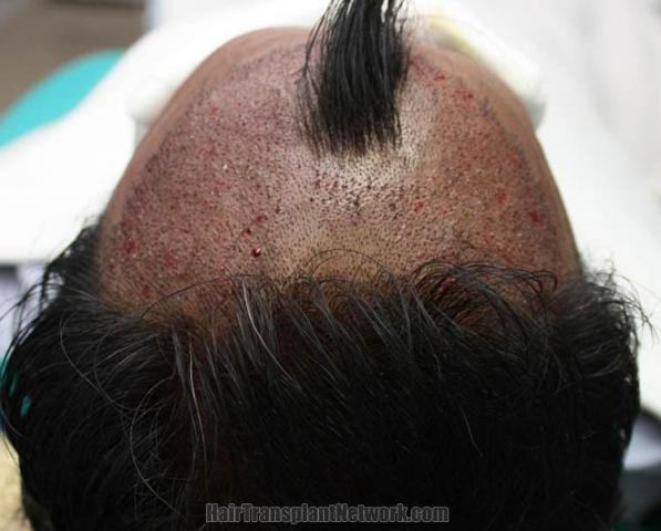 Hair restoration procedure before and after pictures