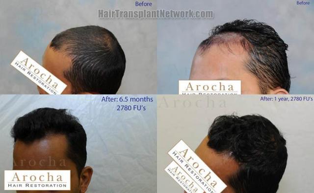 Hair transplantation surgery before and after pictures