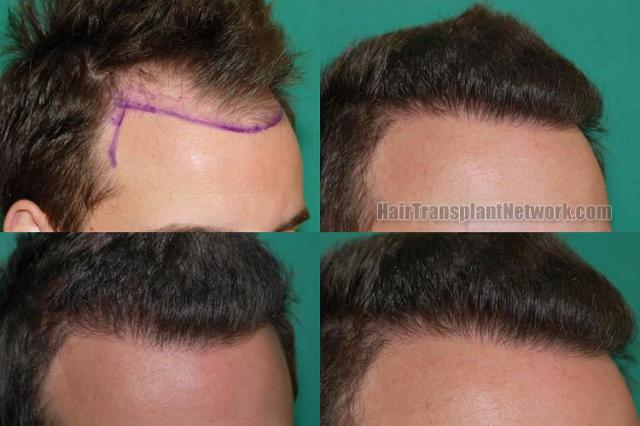 Hair restoration procedure before and after results